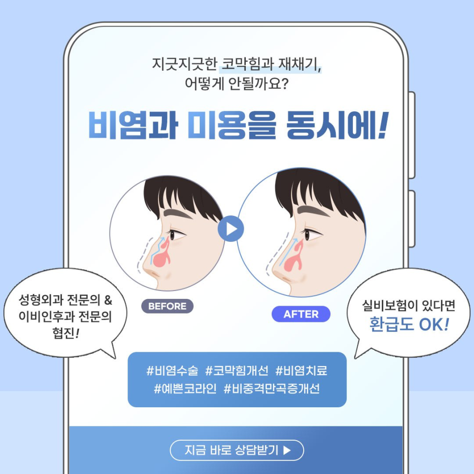 콧물&middot;코막힘&middot;재채기&hellip;비염도 치료하고 코모양도 예뻐지고 싶다면? 강남 비염코성형 관련 이미지 2