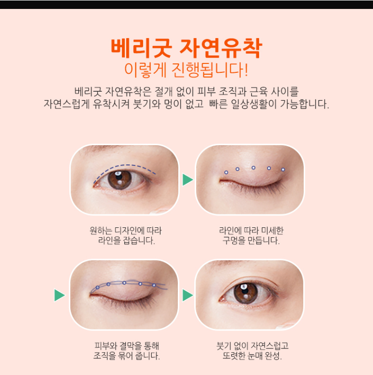 눈성형잘하는곳 찾고있다면? 관련 이미지 3