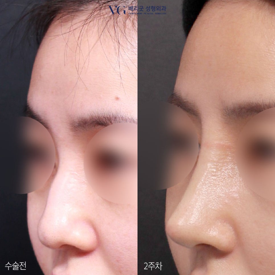 직반코성형? 베리굿성형외과💙 화려하게,자연스럽게✨ 관련 이미지 5