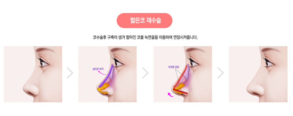 코끝도 베리굿💯#자가늑연골 #반버선 #직반버선 #베리굿성형외과 관련 이미지 4