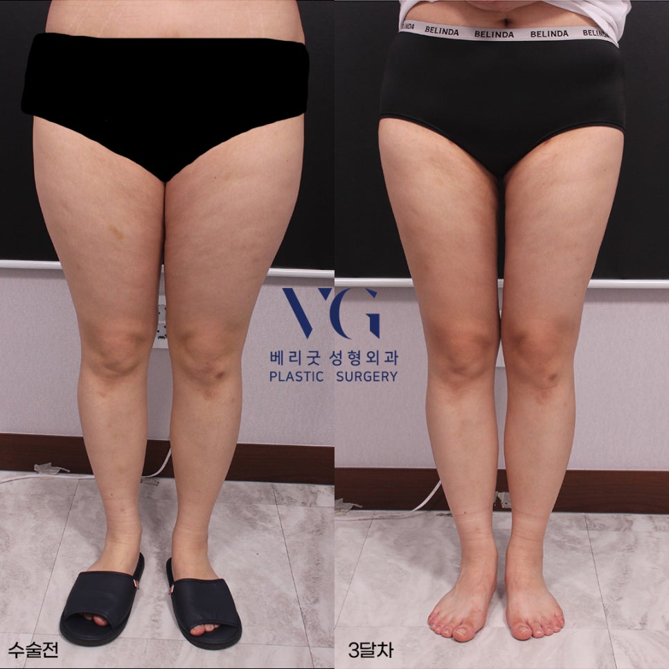 베리굿 몸매💖베리굿 허벅지 지방흡입 전후👙 관련 이미지 1