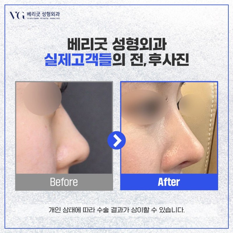 코수술당일붓기 및 변화 후기 , 궁금하다면 관련 이미지 6