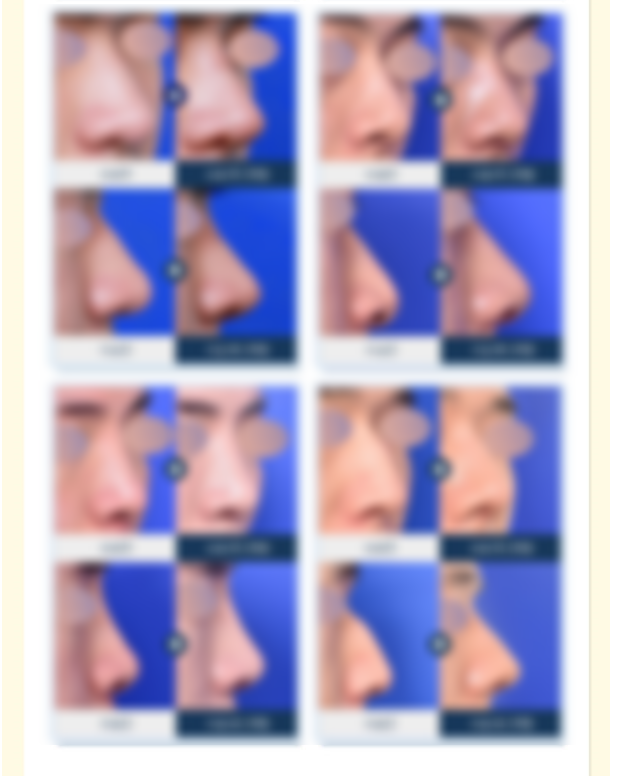 남자코성형! 뭐부터 알아봐야할까? 관련 이미지 5