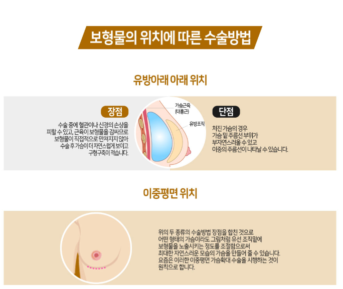 베리굿성형외과 프리미엄 가슴확대! 임영민원장님 기대해봐요! 관련 이미지 7