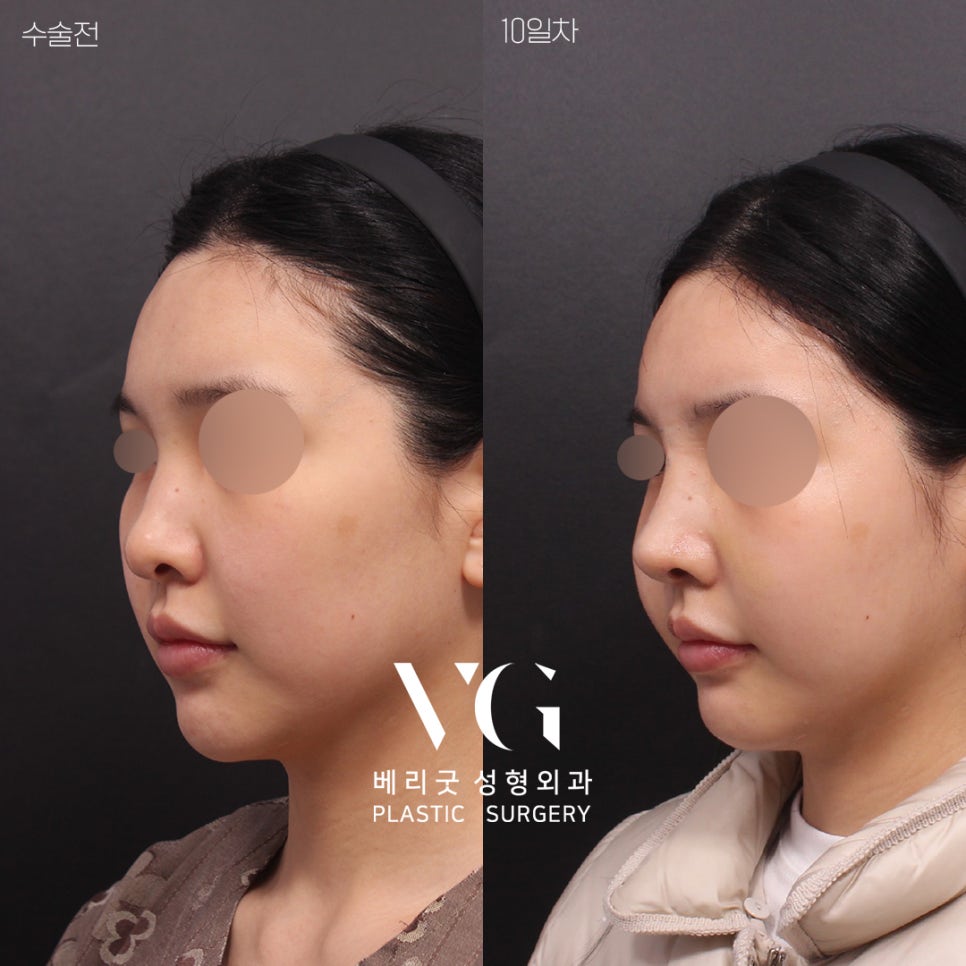 [베리굿성형외과]윤곽수술+코성형 REAL전후💖💖 관련 이미지 3