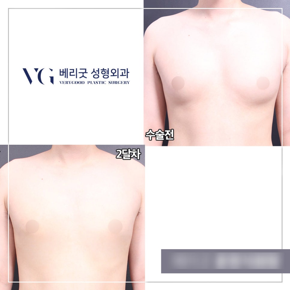 남자여유증수술 베리굿성형외과👨&zwj;⚕️ 관련 이미지 8