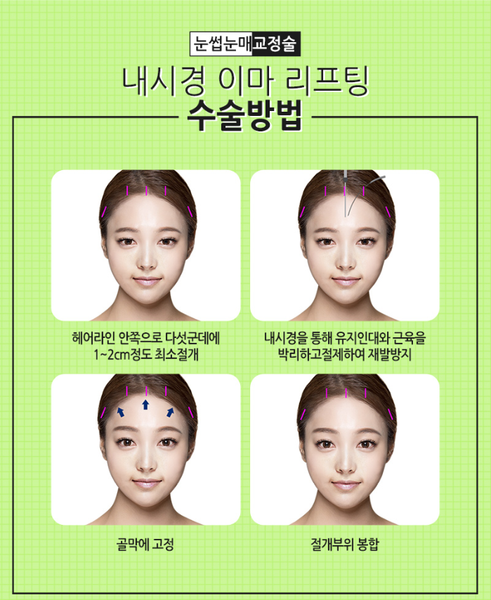 이마리프팅으로 탱탱하고 어리게 관련 이미지 4