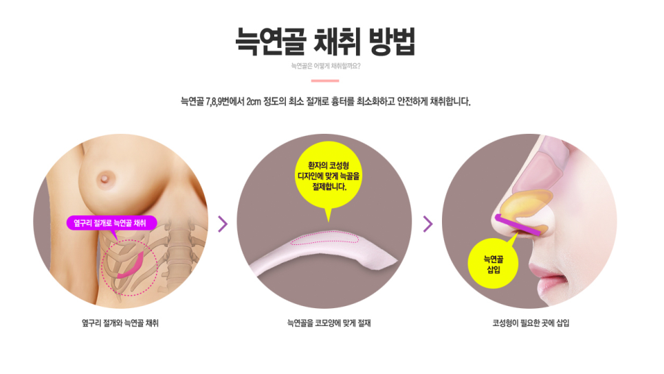 코끝도 베리굿💯#자가늑연골 #반버선 #직반버선 #베리굿성형외과 관련 이미지 3