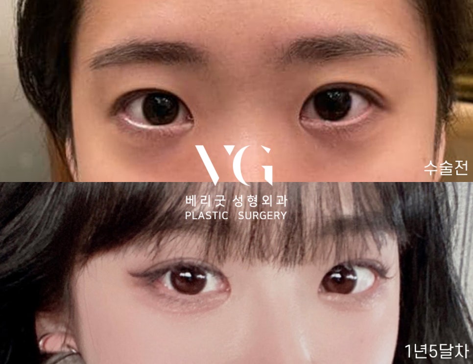 마지막은 쌍수는 베리굿에서 블링블링하게 베리굿 눈재수술전후👀✨ 관련 이미지 8