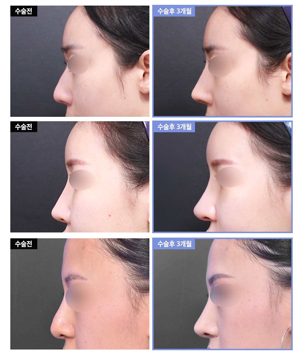 자가연골 코재수술, 기능코 또는 비염까지 한번에 해결 / 강남역 이비인후과 관련 이미지 8