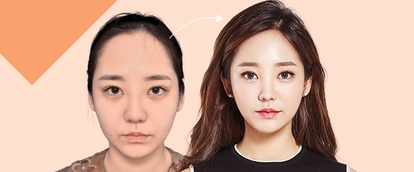 이마축소로 이상적인 이마높이로! 관련 이미지 3