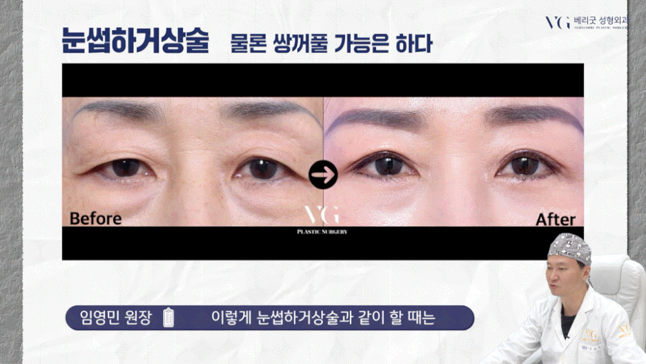 강남중년눈성형 잘하는곳 , 상안검 하안검 눈썹하거상술종류 진행방법 궁금하다면 관련 이미지 27