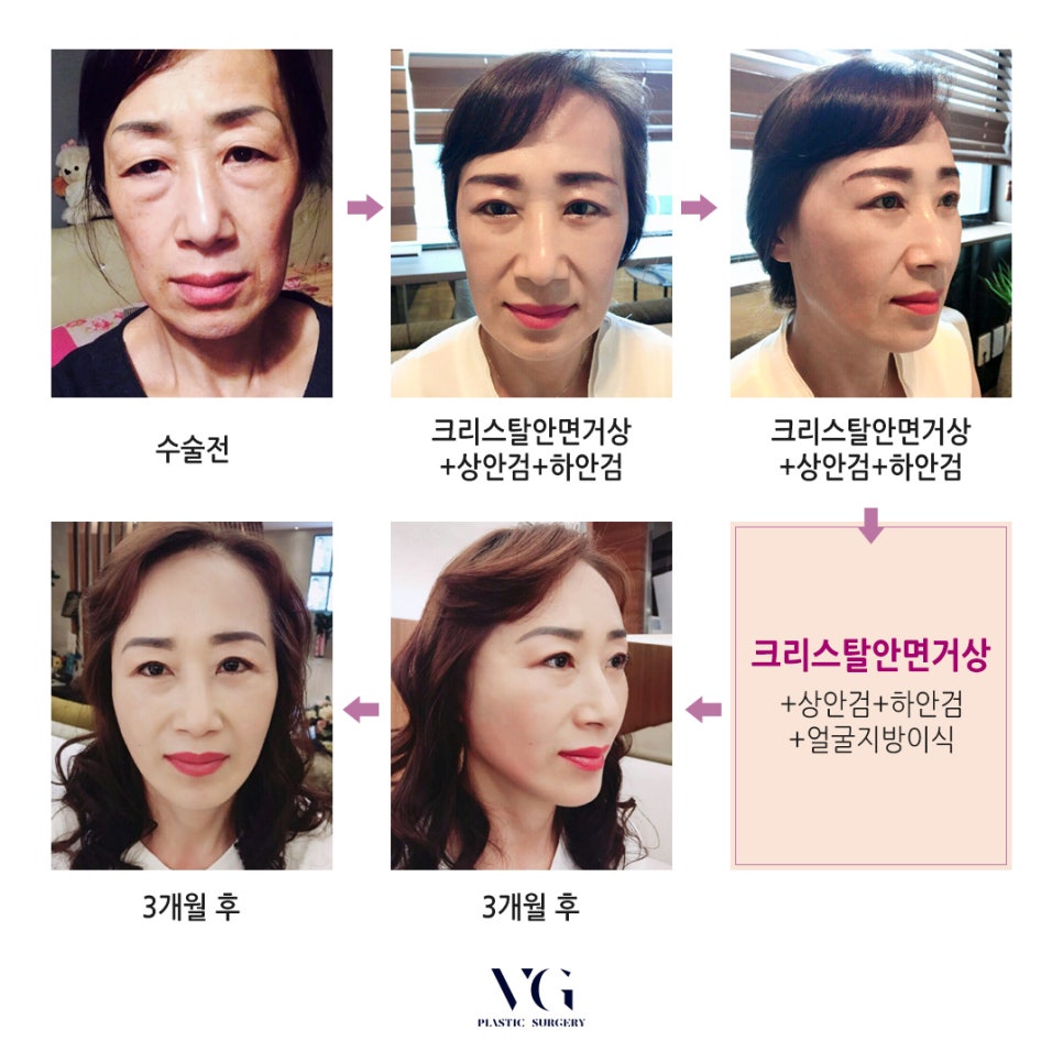 안면거상 가격 / 안면거상 후기 관련 이미지 4