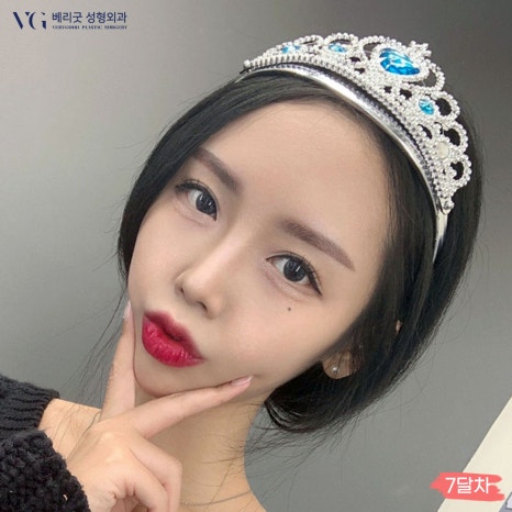 베리굿성형외과 기증늑연골 짧은코교정💖 관련 이미지 7