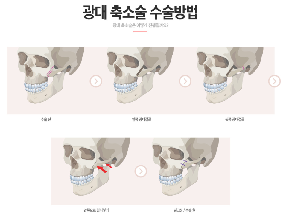 강남역광대축소 후기가 궁금해? 베리굿 광대축소💖 관련 이미지 4