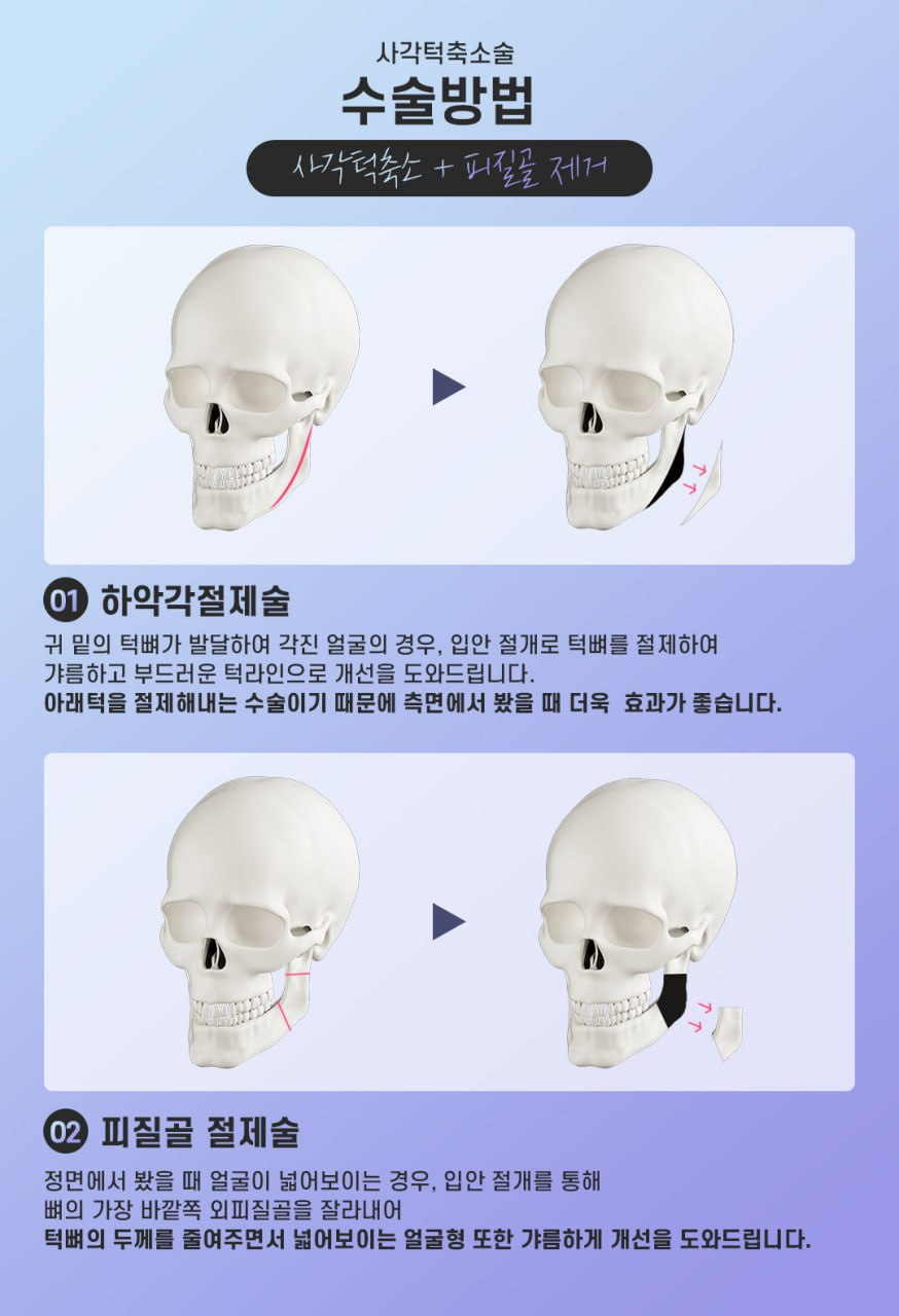 강남역 사각턱축소 수술 전 필수 체크 ? 신경 위치와 절제 범위 분석 중요해 관련 이미지 4
