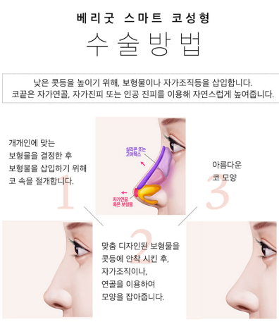 첫코도 스마트하게💖베리굿성형외과 스마트코성형 관련 이미지 3