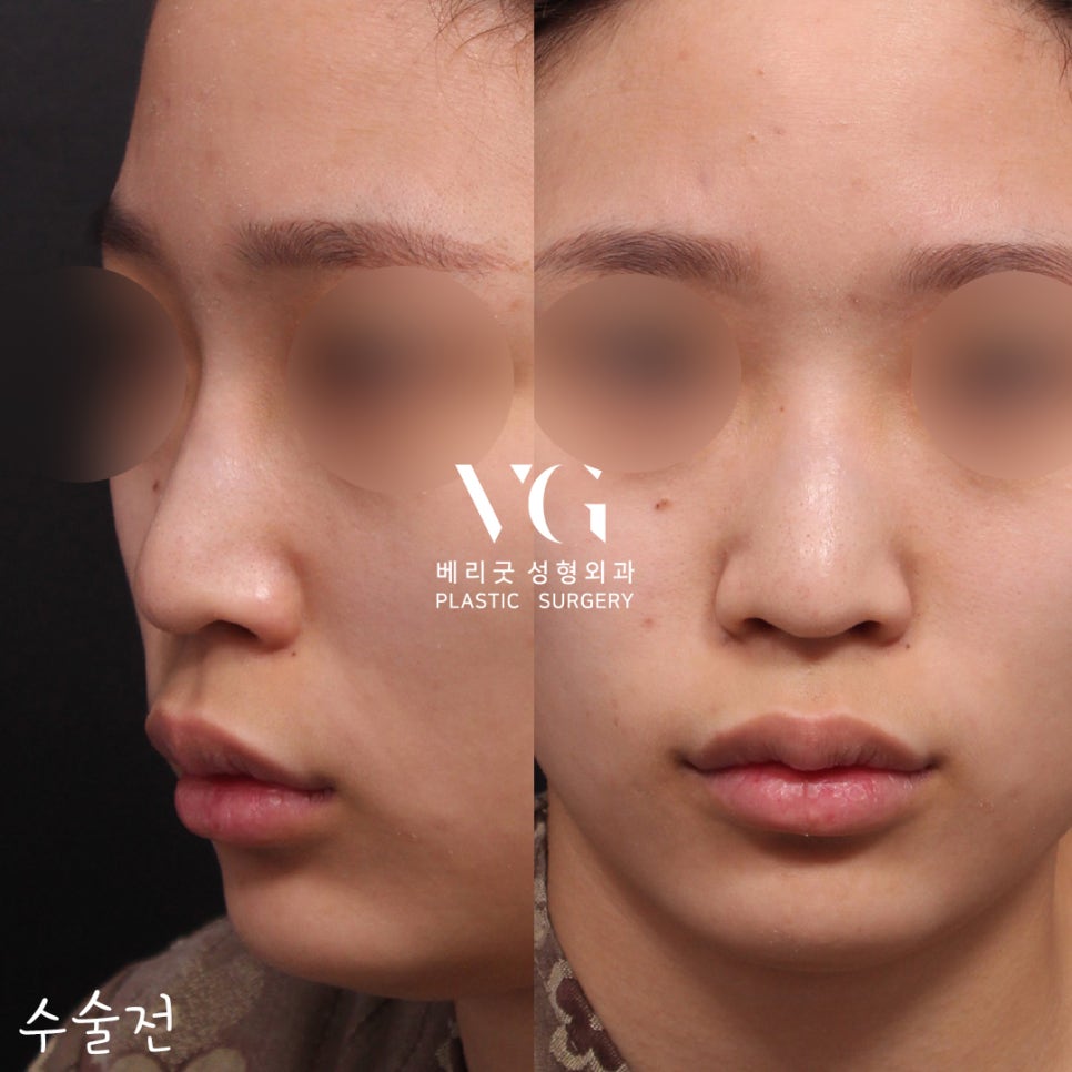 직반코성형전후💖베리굿성형외과 관련 이미지 2