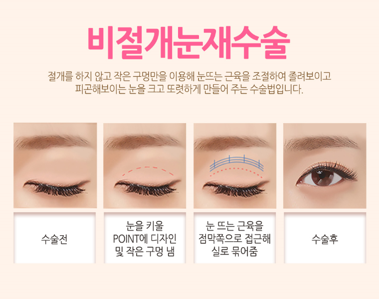 눈재수술 전문, 베리굿성형외과 임영민 원장님 관련 이미지 5