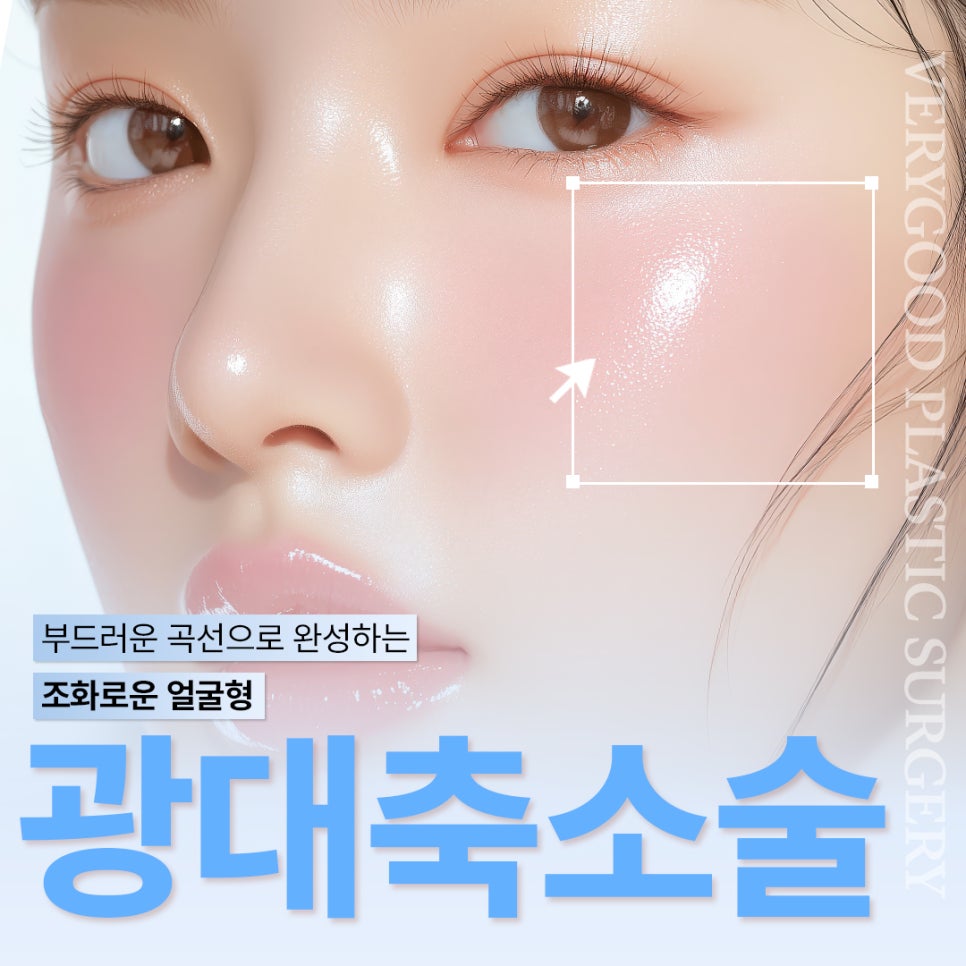 Gangnam Verygood Plastic Surgery Cheekbone Reduction Surgery A to Z for Improving Prominent Side Cheekbones and Creating a Softer Impression image 4