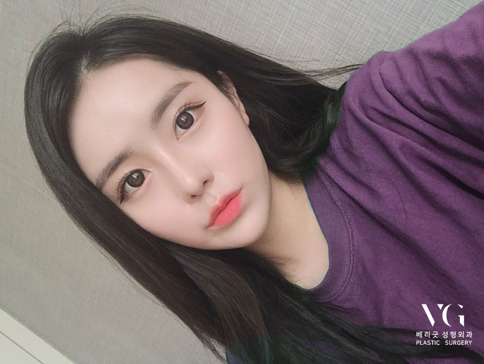 베리굿 눈매교정으로 졸려보이는 안검하수 탈출~! 관련 이미지 2