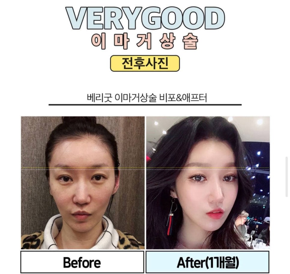 이마거상술 잘하는곳,이마거상술 가격 알아보자 관련 이미지 5