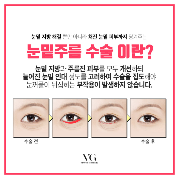 40~50대 눈밑주름고민, 하안검수술로 해결하자! 관련 이미지 2