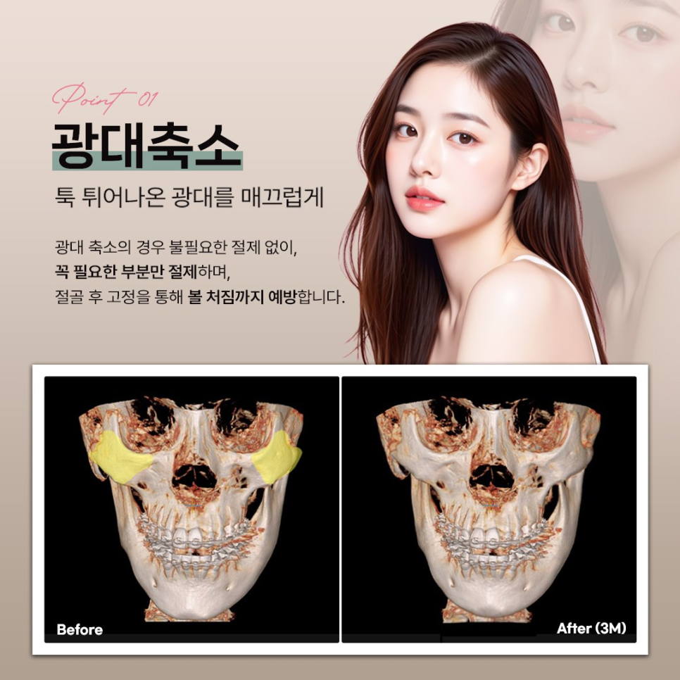 안면윤곽 수술 전 체크해야 할 3D-CT 정밀 분석의 중요성 관련 이미지 3