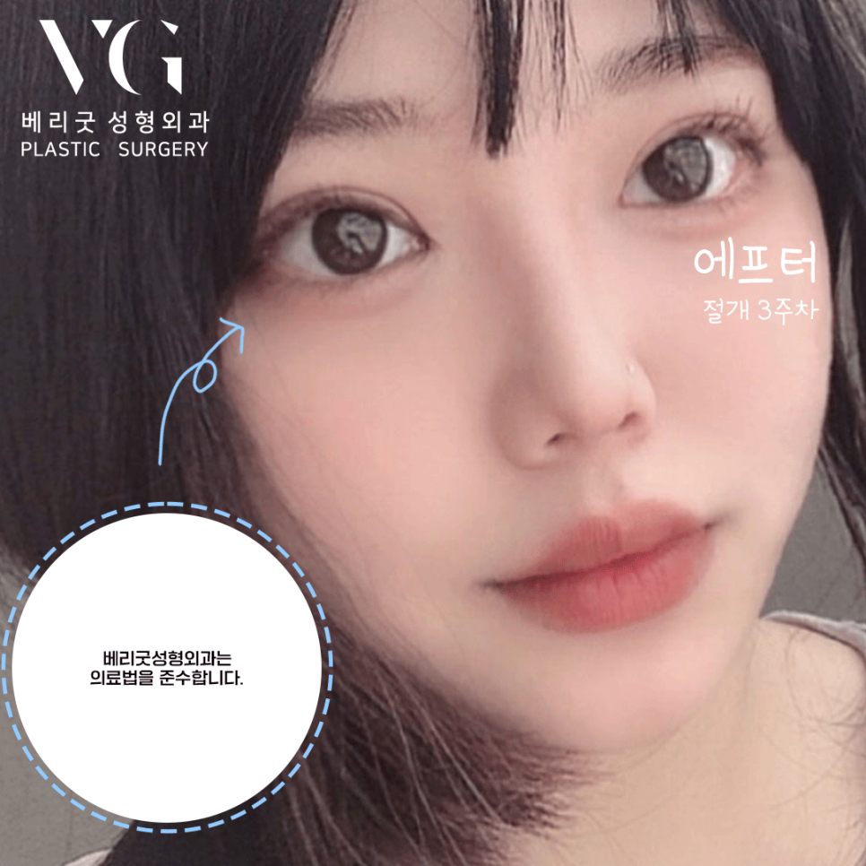 절개 쌍커풀 쌍수👀❣ 잘하는곳 베리굿성형외과❤ 관련 이미지 1