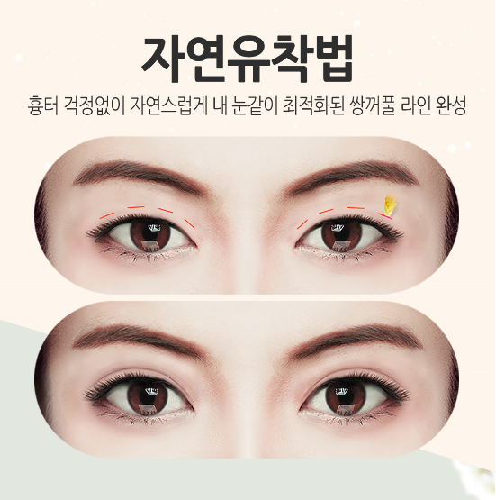 내게 맞는 라인으로 쌍꺼풀수술 잘하는곳 관련 이미지 2