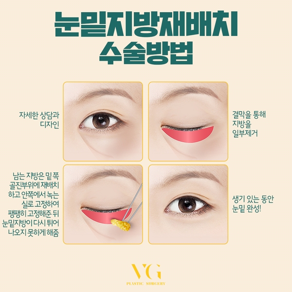 칙칙한 눈밑! 눈밑지방재배치로 환하고 생기있게! 관련 이미지 4