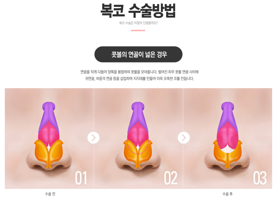 주먹코 큰코 복코!! 베리굿성형외과에서 복코 교정하자 관련 이미지 3