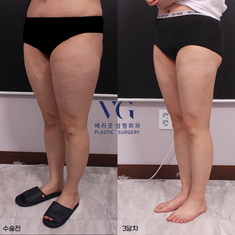 베리굿 몸매💖베리굿 허벅지 지방흡입 전후👙 관련 이미지 2