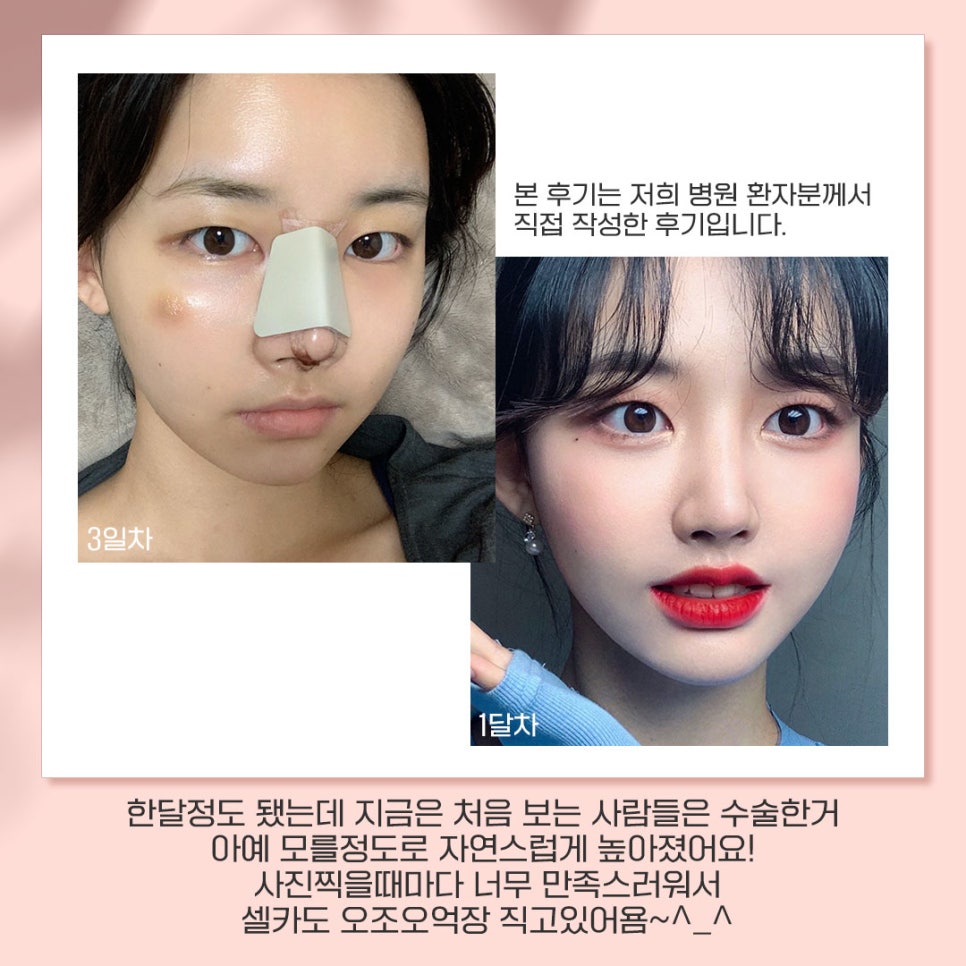 베리굿성형외과가 추천하는 성형별 추천👏 관련 이미지 3