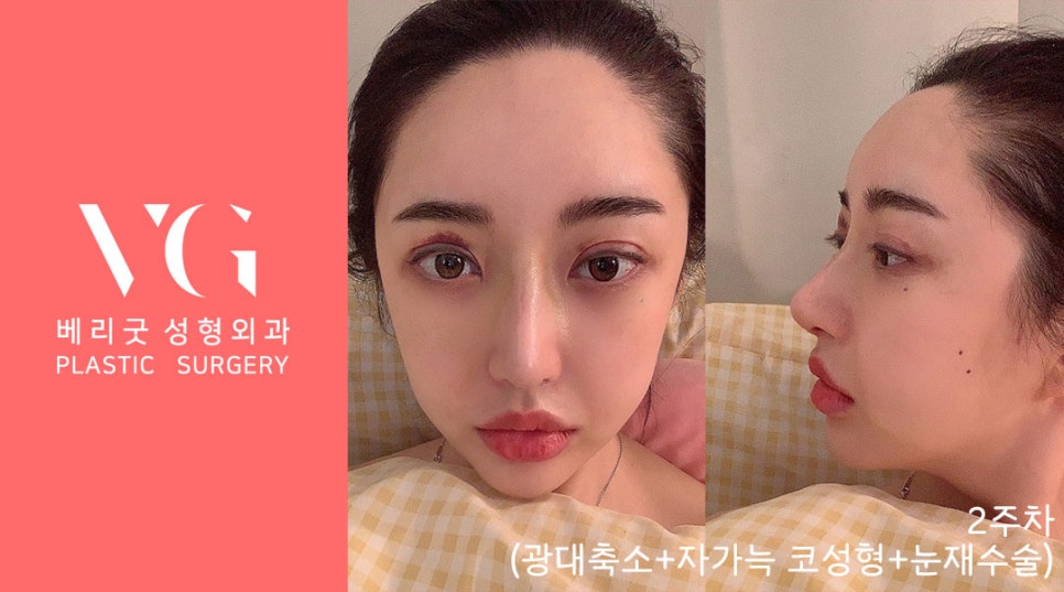 베리굿성형외과 (광대축소+눈재수술+자가늑 코) 리얼스토리💯 관련 이미지 3