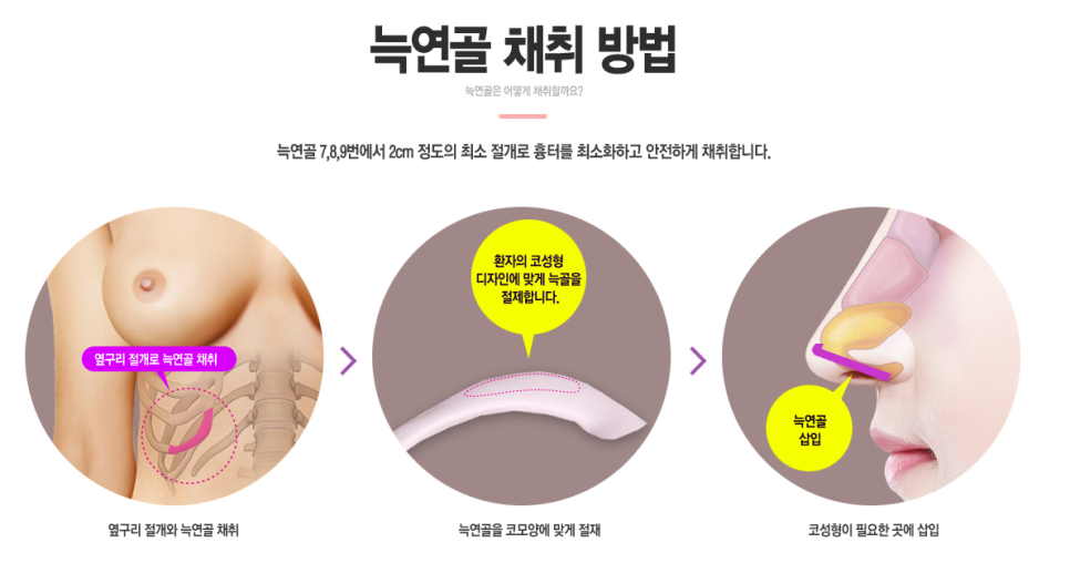 화려한 코라인, 베리굿성형외과 자가늑코성형✨ 관련 이미지 4