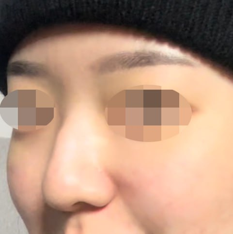 Primary Rhinoplasty, Osteotomy, Hump Correction, Septoplasty, Inferior Turbinate Resection | 베리굿성형외과 Before-and-After Review image 1
