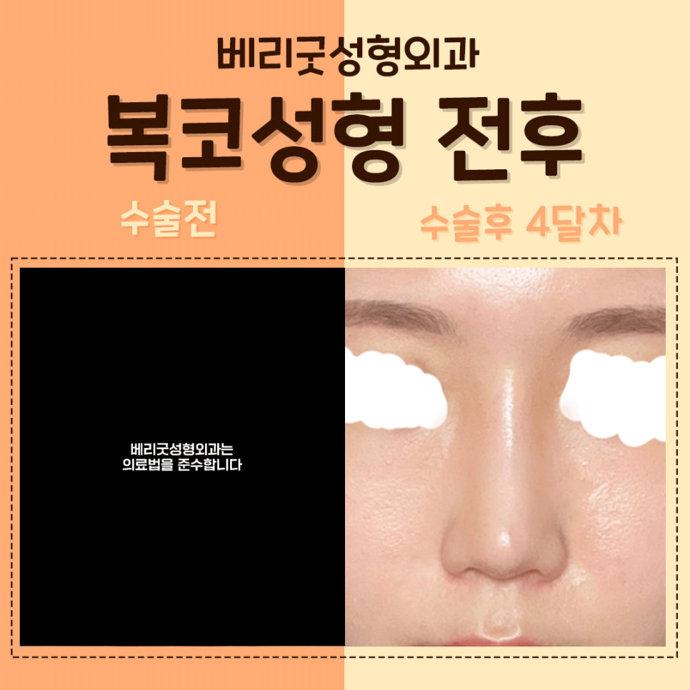 #복코성형 #복코수술 역시😘 #베리굿성형외과 관련 이미지 2