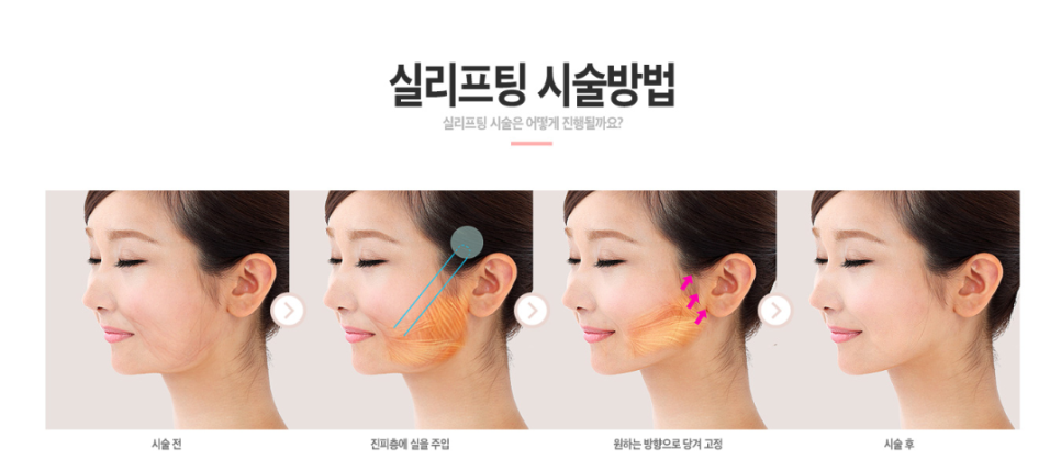 실리프팅 종류 내게 알맞는 실로 확실하게! 관련 이미지 4