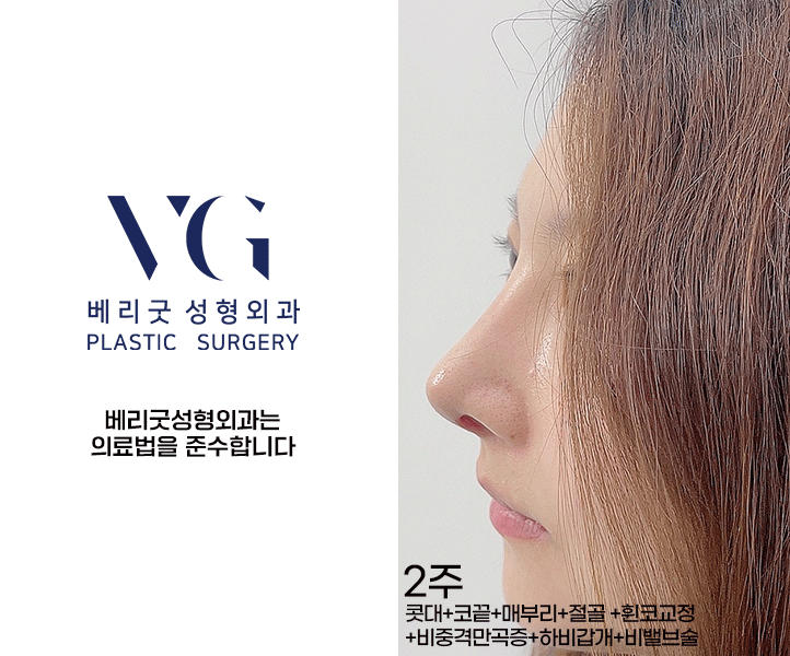 베리굿 비염코성형✨비염수술과 코성형을 동시에? 관련 이미지 7