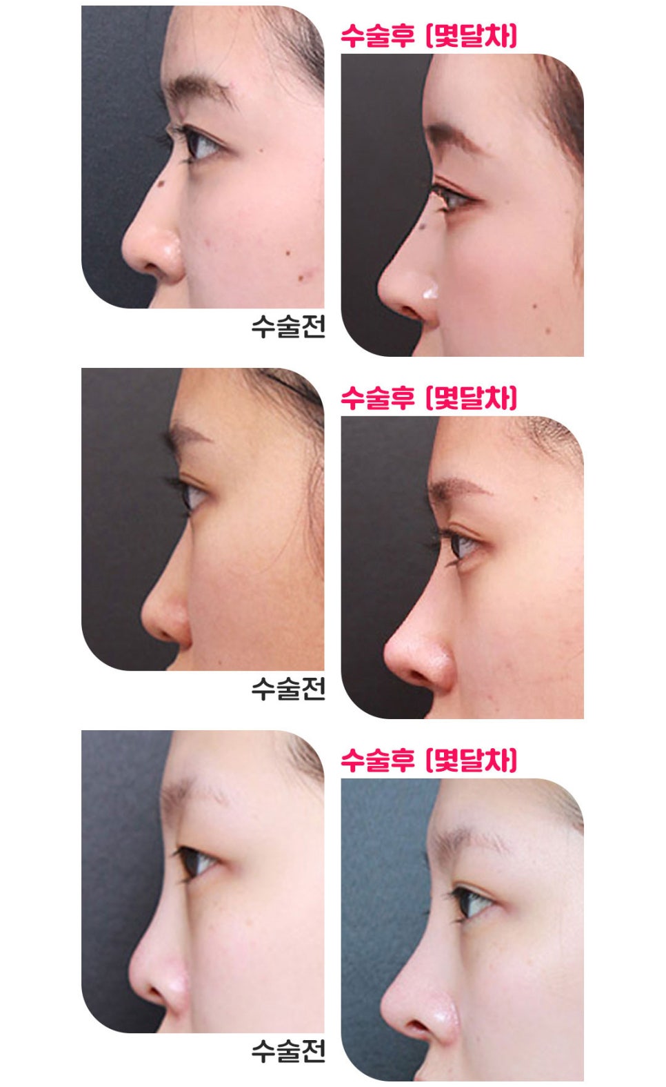 뚱뚱한코, 짧은코, 퍼진코 전부 고민된다면? MZ코가 답이다 관련 이미지 4