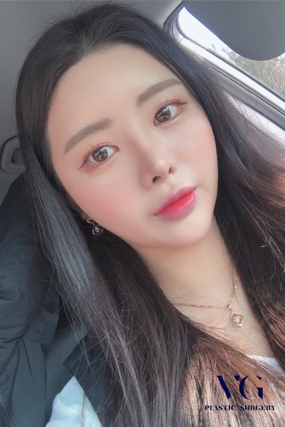 얼굴지방흡입, 후기 확인하고 성공적으로! 관련 이미지 3