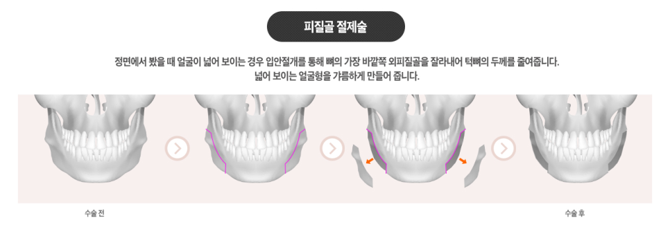 안면윤곽 3D-CT로 뼈구조부터 확인하고 관련 이미지 3