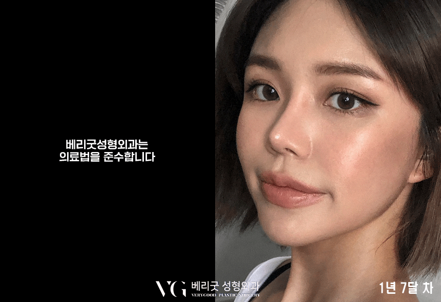 낮은 콧대 모여라❣❣ 베리굿 코끝성형으로 예뻐지자✨ 관련 이미지 7