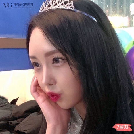 베리굿성형외과 기증늑연골 짧은코교정💖 관련 이미지 6