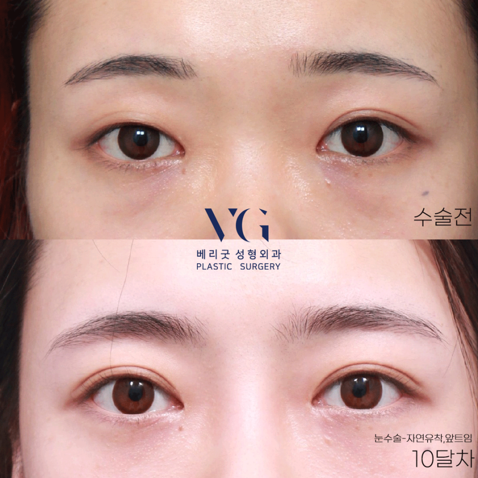 베리굿하게💖베리굿성형외과 눈성형전후 관련 이미지 1