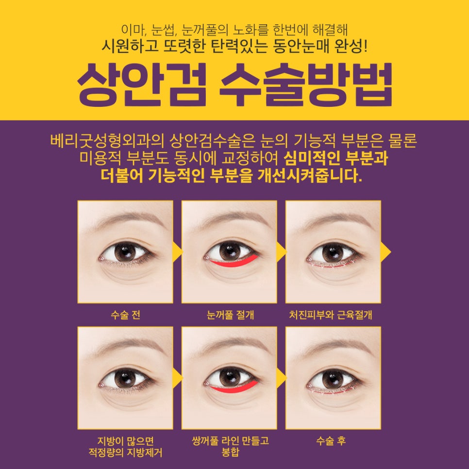 40대~50대 처진 눈꺼풀 상안검수술로 시원하게! 관련 이미지 4