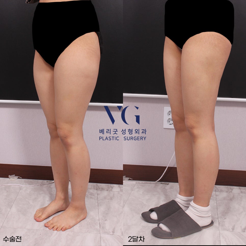 베리굿 몸매💖베리굿 허벅지 지방흡입 전후👙 관련 이미지 5