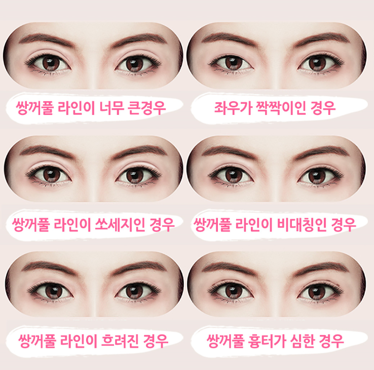 눈재수술 전문, 베리굿성형외과 임영민 원장님 관련 이미지 4