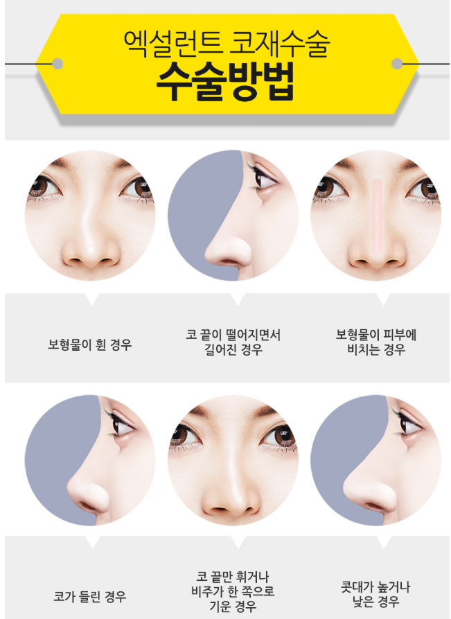 베리굿성형외과 엑설런트 코재수술! 다시 살아나는 미모의 시작~ 강남역성형외과 관련 이미지 4